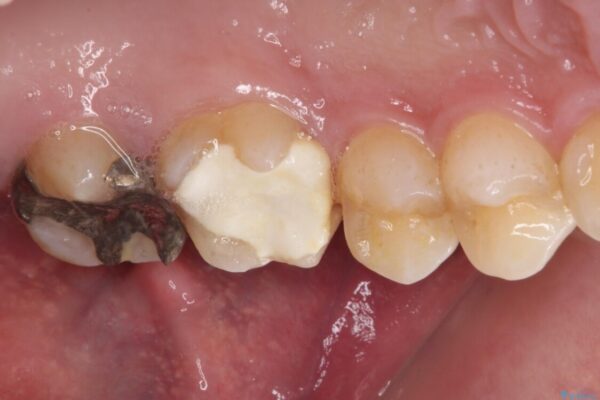 強い咬合力で生じた亀裂からむし歯に　奥歯のゴールドインレー治療 治療前画像
