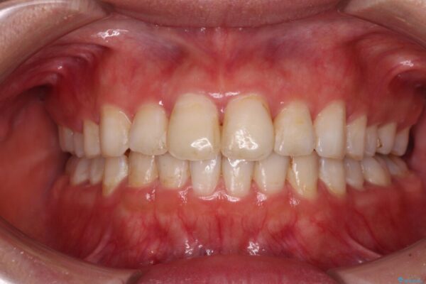 前歯の捻れを改善　インビザラインによる矯正治療 アフター