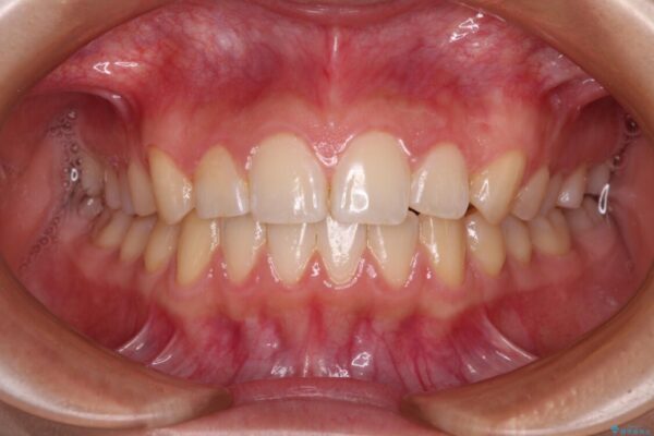 カリエール・ディスタライザーとインビザラインを用いた奥歯の咬み合わせ改善 アフター