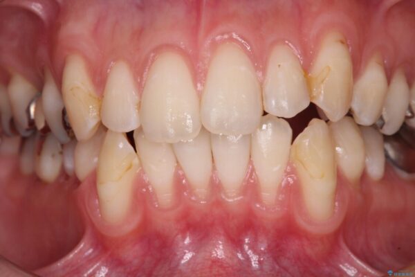 磨きすぎて傷が付くほどの歯根　歯肉移植術による根面被覆 治療前画像