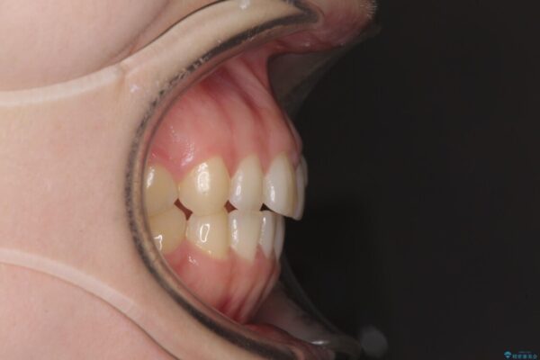 気になる残存乳歯と八重歯　ワイヤー矯正を併用したインビザライン治療 治療前画像