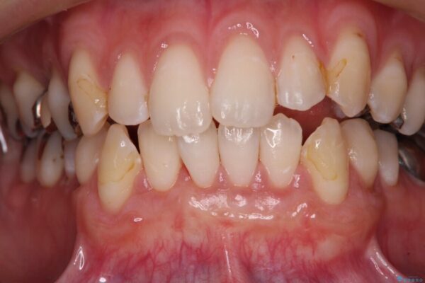 磨きすぎて傷が付くほどの歯根　歯肉移植術による根面被覆 治療後画像