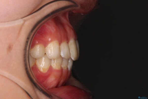 前歯の捻れを改善　インビザラインによる矯正治療 治療後画像