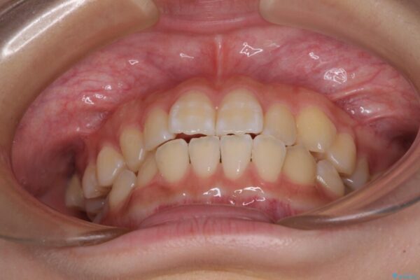 むし歯になりやすい奥歯　補助装置で一気に解決 治療前画像