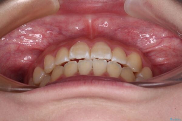 むし歯になりやすい奥歯　補助装置で一気に解決 治療後画像
