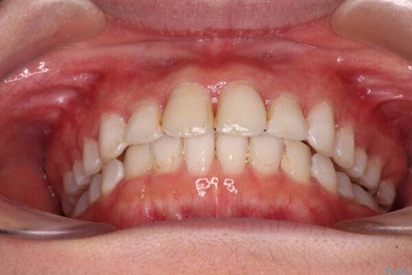 前歯の捻れを改善　インビザラインによる矯正治療 治療途中画像
