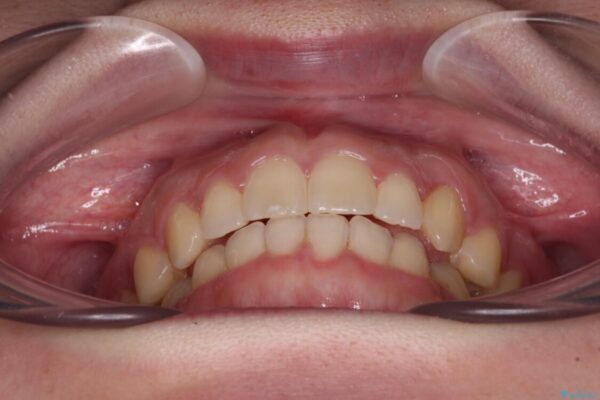 気になる残存乳歯と八重歯　ワイヤー矯正を併用したインビザライン治療 治療後画像