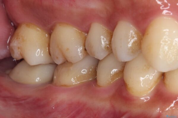セラミックは無理と言われた奥歯　フルジルコニアクラウンによる補綴治療 治療後画像