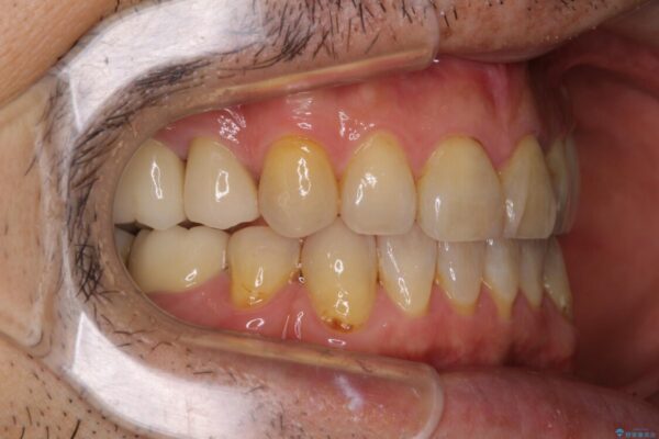 むし歯や銀歯が気になる　後戻りの再矯正治療とむし歯治療 治療途中画像
