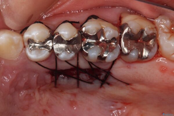 磨きすぎて傷が付くほどの歯根　歯肉移植術による根面被覆 治療途中画像