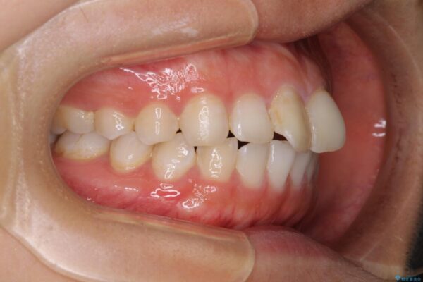 前歯の捻れを改善　インビザラインによる矯正治療 治療前画像