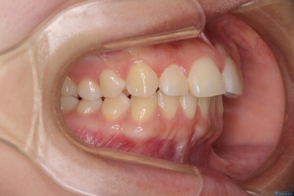 カリエール・ディスタライザーとインビザラインを用いた奥歯の咬み合わせ改善 治療前画像
