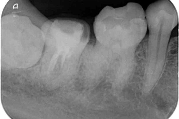 セラミックは無理と言われた奥歯　フルジルコニアクラウンによる補綴治療 治療前画像