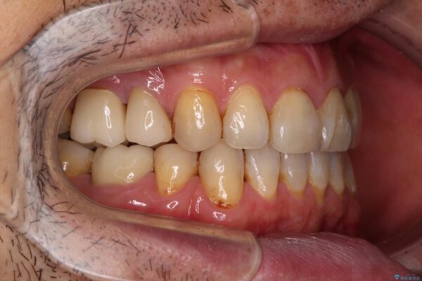 むし歯や銀歯が気になる　後戻りの再矯正治療とむし歯治療 治療後画像