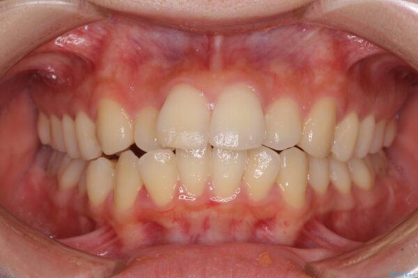 短期間で口元の突出感を改善　ワイヤー装置での抜歯矯正 ビフォー