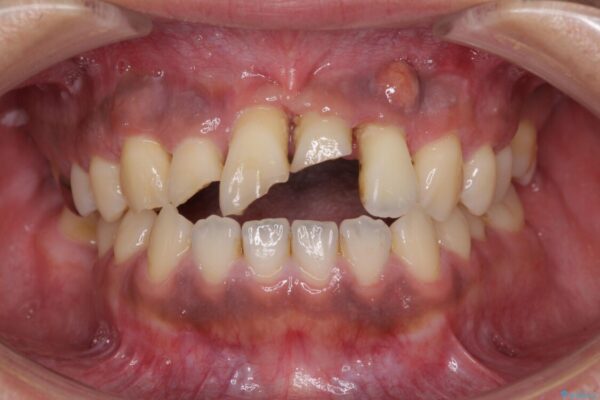事故で抜歯となった前歯　ブリッジやインプラントによる補綴治療 ビフォー