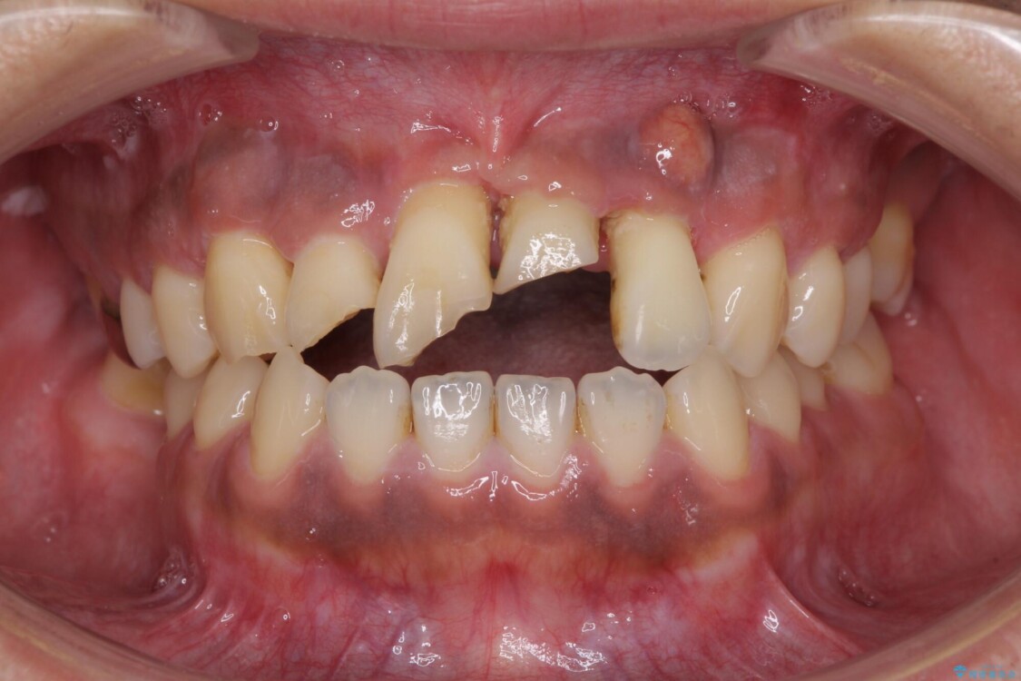 事故で抜歯となった前歯　ブリッジやインプラントによる補綴治療 治療前