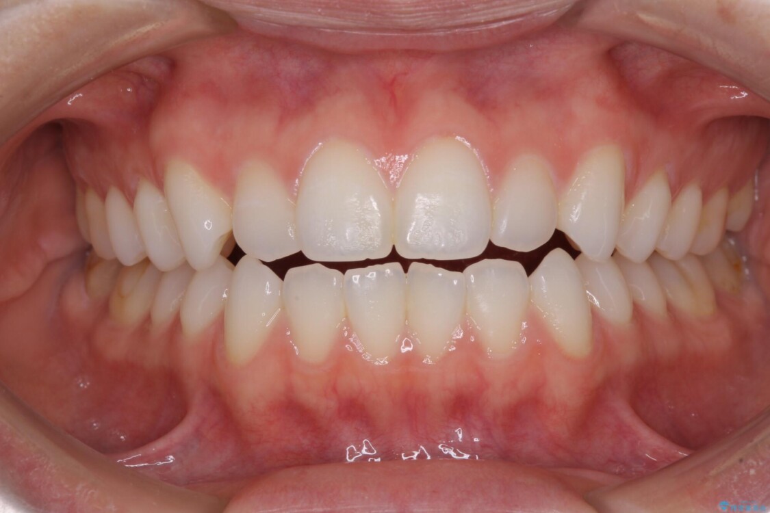 上下前歯が接触しない　オープンバイトをインビザラインで改善 治療前