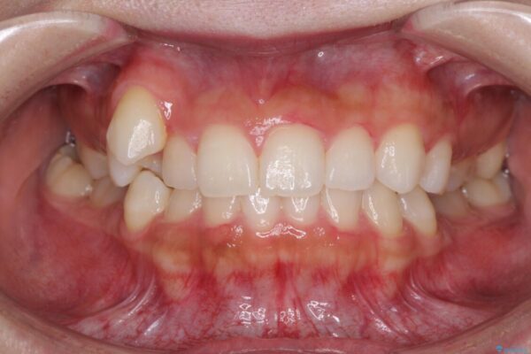 八重歯を改善　目立たないワイヤー装置での矯正治療 ビフォー
