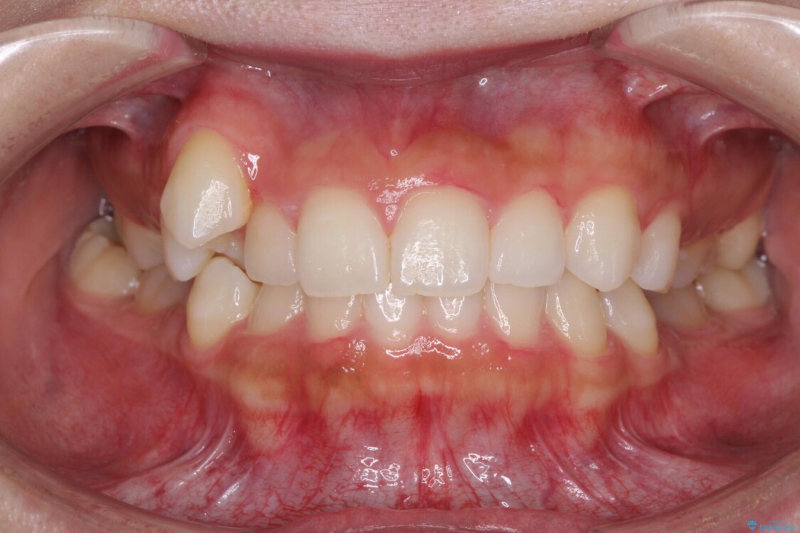 八重歯を改善　目立たないワイヤー装置での矯正治療 治療前