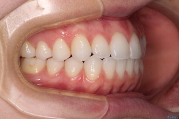 上下前歯が接触しない　オープンバイトをインビザラインで改善 治療途中画像
