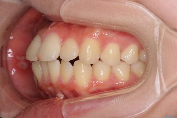 短期間で口元の突出感を改善　ワイヤー装置での抜歯矯正 治療前画像
