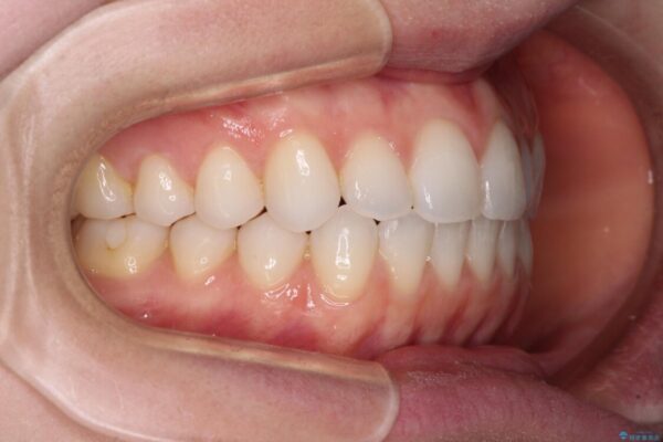 上下前歯が接触しない　オープンバイトをインビザラインで改善 治療後画像