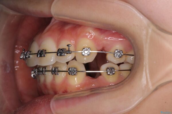 短期間で口元の突出感を改善　ワイヤー装置での抜歯矯正 治療途中画像