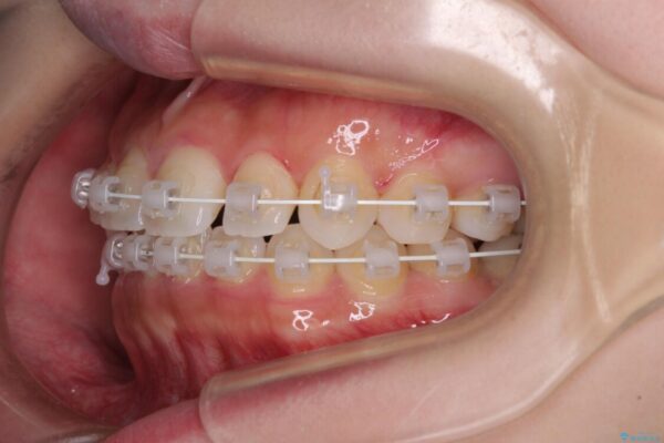 八重歯を改善　目立たないワイヤー装置での矯正治療 治療途中画像