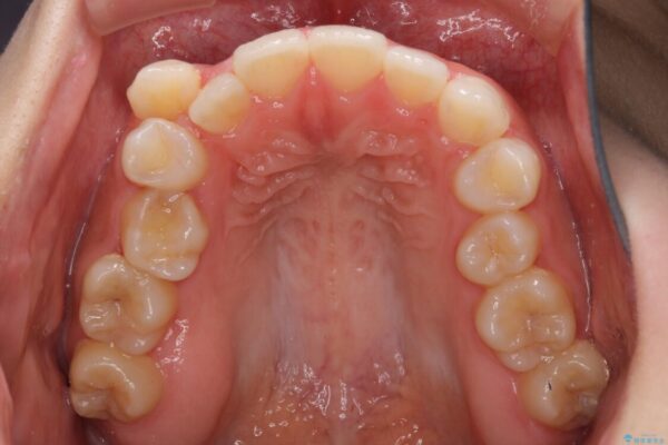 八重歯を改善　目立たないワイヤー装置での矯正治療 治療前画像