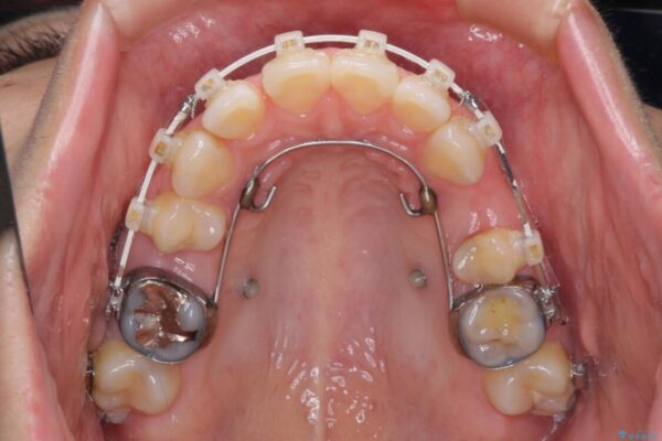 口元の突出感改善　なるべく銀歯を抜歯してワイヤー矯正 治療途中画像