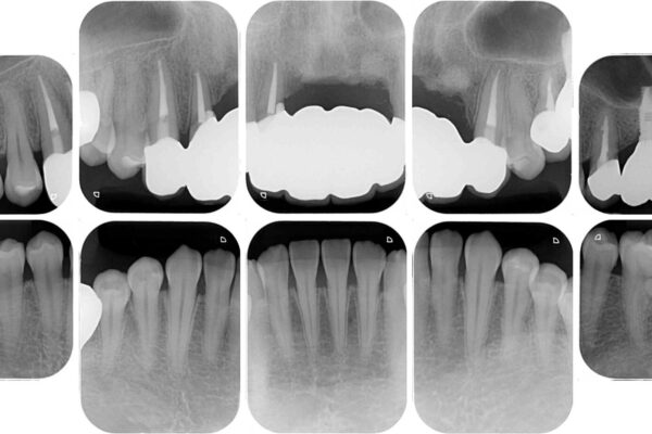 事故で抜歯となった前歯　ブリッジやインプラントによる補綴治療 治療後画像