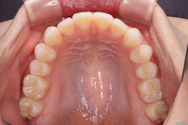 上下前歯が接触しない　オープンバイトをインビザラインで改善 治療途中画像