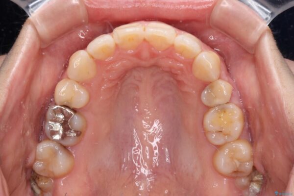 口元の突出感改善　なるべく銀歯を抜歯してワイヤー矯正 治療後画像