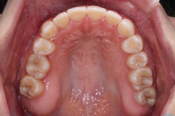 八重歯を改善　目立たないワイヤー装置での矯正治療 治療後画像