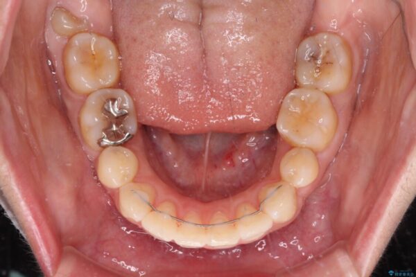 口元の突出感改善　なるべく銀歯を抜歯してワイヤー矯正 治療後画像