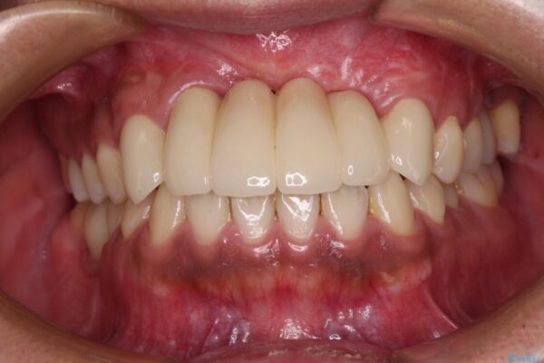 事故で抜歯となった前歯　ブリッジやインプラントによる補綴治療 アフター
