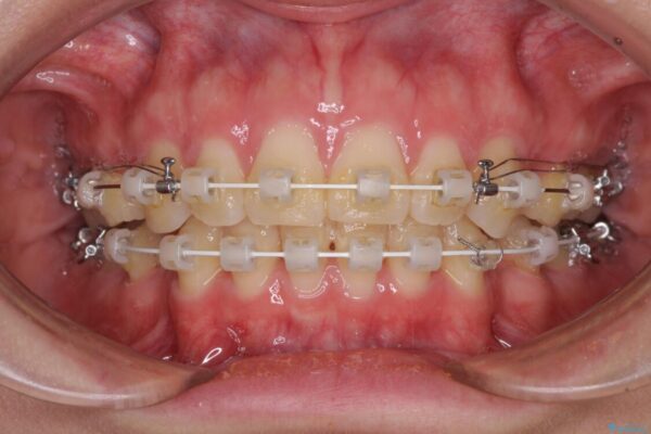 上顎前突　目立たないワイヤー装置での抜歯矯正 治療途中画像