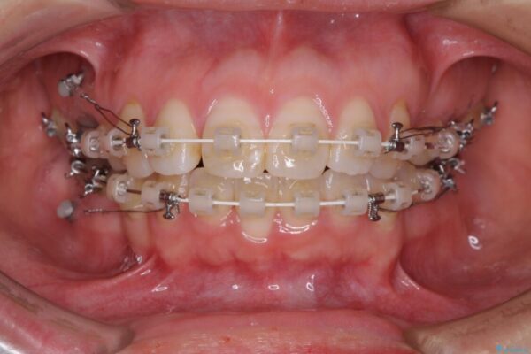 口元の突出感改善　なるべく銀歯を抜歯してワイヤー矯正 治療途中画像