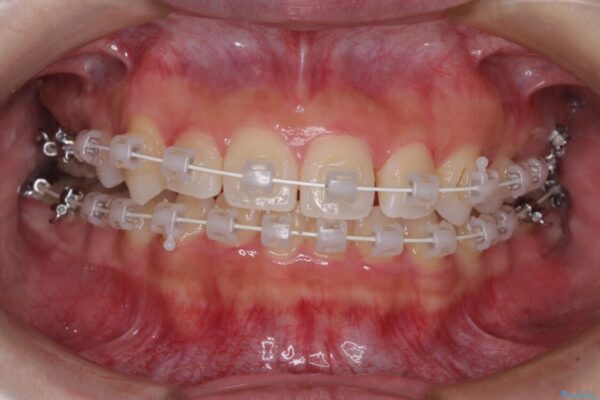 八重歯を改善　目立たないワイヤー装置での矯正治療 治療途中画像