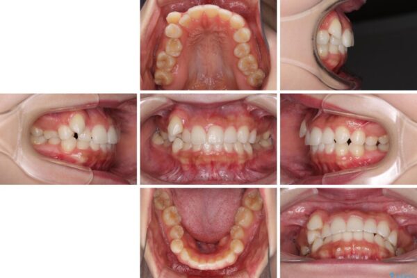 八重歯を改善　目立たないワイヤー装置での矯正治療 治療前画像