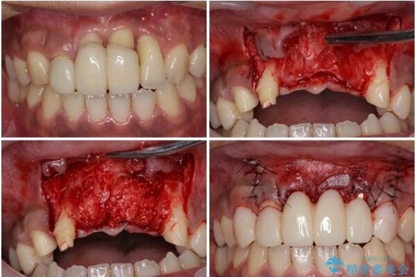 事故で抜歯となった前歯　ブリッジやインプラントによる補綴治療 治療途中画像