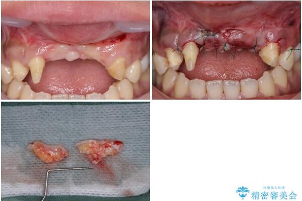 事故で抜歯となった前歯　ブリッジやインプラントによる補綴治療 治療途中画像