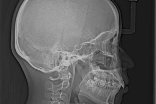 上顎前突　目立たないワイヤー装置での抜歯矯正 治療前画像