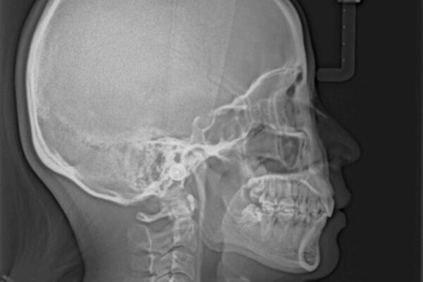 上顎前突　目立たないワイヤー装置での抜歯矯正 治療後画像