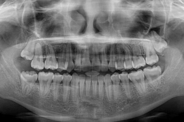 八重歯を改善　目立たないワイヤー装置での矯正治療 治療後画像