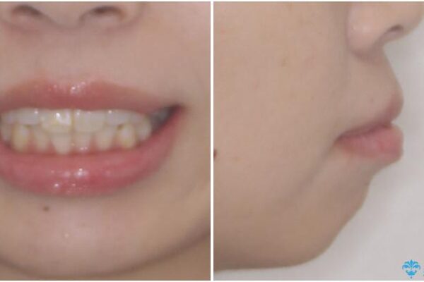 口元の突出感改善　なるべく銀歯を抜歯してワイヤー矯正 治療前画像
