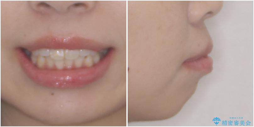 口元の突出感改善　なるべく銀歯を抜歯してワイヤー矯正 治療前