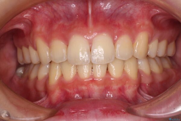 短期間で口元の突出感を改善　ワイヤー装置での抜歯矯正 アフター
