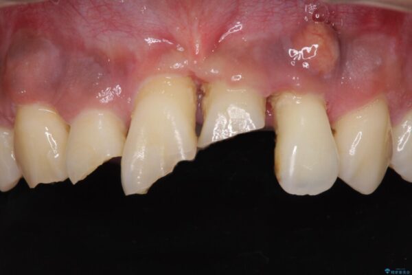 事故で抜歯となった前歯　ブリッジやインプラントによる補綴治療 治療前画像